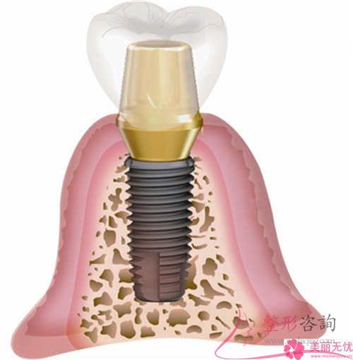 什么是种植牙与所需花销
