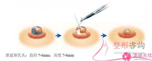 乳头内缩矫治风险性有什么？