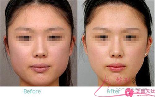 瘦苹果肌用botox<a href=http://www.washiqing.com/listinfo-631-0.html target=_blank class=infotextkey>瘦脸</a>针价格效果比怎样