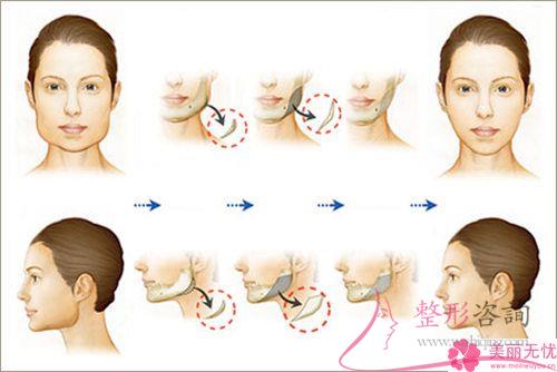 硅胶或膨体隆下巴颏儿整形手术价格表